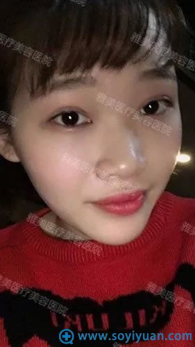 在雅美做隆鼻手术前塌鼻子照片 在雅美做隆鼻手术前塌鼻子照片