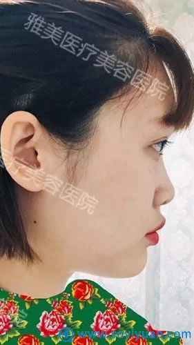 隆鼻手术前侧面照片 隆鼻手术前侧面照片