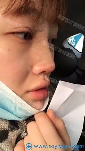 在衡阳雅美做完隆鼻术当天效果 在衡阳雅美做完隆鼻术当天效果