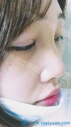 雅美姚<!--<i data=20240710 data-id=16293></i>-->院长隆鼻案例5天效果 雅美姚<!--<i data=20240710 data-id=16293></i>-->院长隆鼻案例5天效果