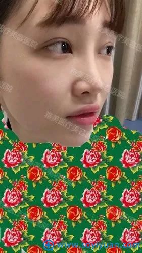 做完鼻综合隆鼻手术15天恢复照 做完鼻综合隆鼻手术15天恢复照