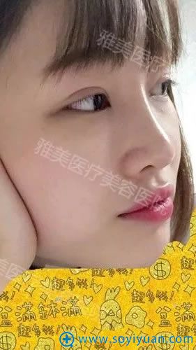 选择衡阳雅美做隆鼻手术30天效果 选择衡阳雅美做隆鼻手术30天效果