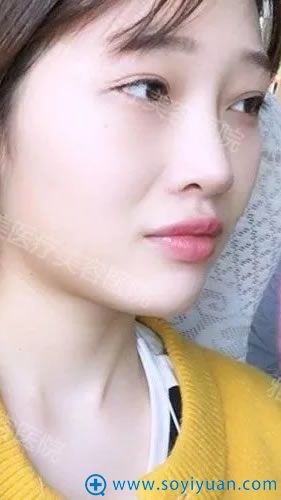 衡阳雅美鼻综合隆鼻案例100天效果 衡阳雅美鼻综合隆鼻案例100天效果