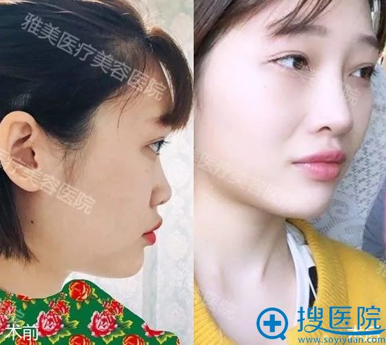 衡阳雅美姚<!--<i data=20240710 data-id=16293></i>-->隆鼻案例对比图 衡阳雅美姚<!--<i data=20240710 data-id=16293></i>-->隆鼻案例对比图