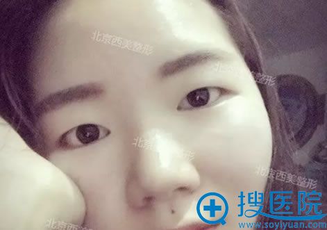 手术前的单眼皮眼睛 手术前的单眼皮眼睛