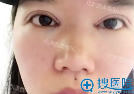 选择<!--<i data=20240710 data-id=7853></i>-->刘野做双眼皮当天效果 选择<!--<i data=20240710 data-id=7853></i>-->刘野做双眼皮当天效果