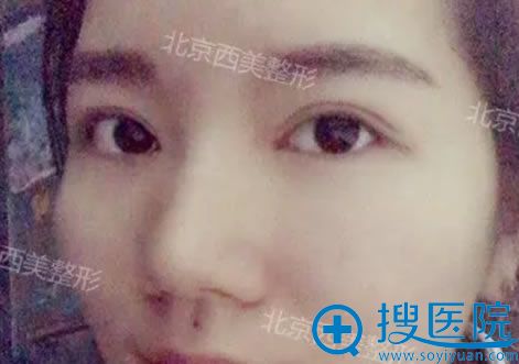 在<!--<i data=20240710 data-id=7853></i>-->做完双眼皮10天效果 在<!--<i data=20240710 data-id=7853></i>-->做完双眼皮10天效果