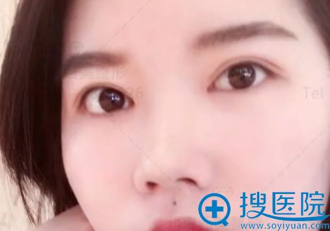 <!--<i data=20240710 data-id=7853></i>-->刘野医生双眼皮案例 <!--<i data=20240710 data-id=7853></i>-->刘野医生双眼皮案例