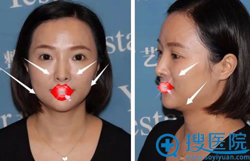 合肥艺兴员工做面部线雕前 合肥艺兴员工做面部线雕前