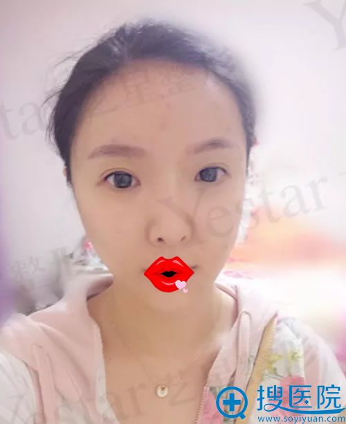 合肥艺兴员工面部线雕术后2天效果 合肥艺兴员工面部线雕术后2天效果
