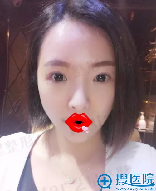 线雕和玻尿酸填充术后3天效果 线雕和玻尿酸填充术后3天效果