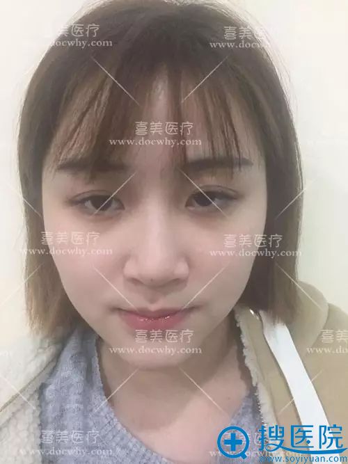 隆鼻可以用别人的肋软骨吗?上海喜美王会勇异体肋软骨案例反馈