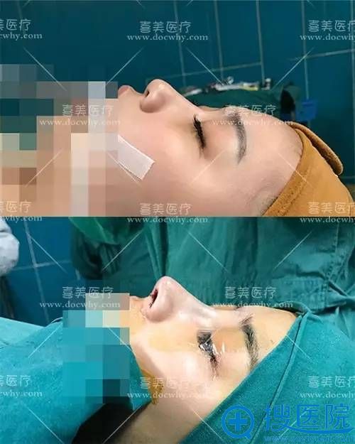 上海喜美<!--<i data=20240710 data-id=16268></i>-->院长异体肋软骨隆鼻术后即刻效果 上海喜美<!--<i data=20240710 data-id=16268></i>-->院长异体肋软骨隆鼻术后即刻效果
