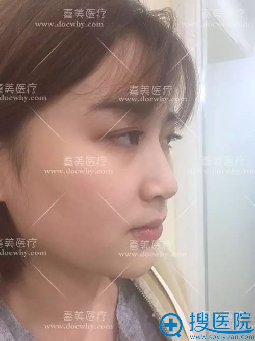 隆鼻术前侧面图片 隆鼻术前侧面图片