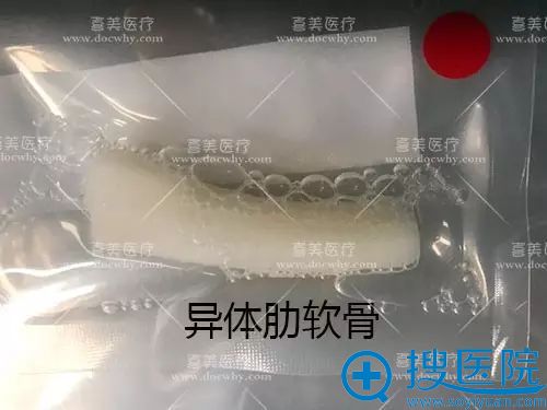 上海喜美整形医院异体肋软骨图片 上海喜美整形医院异体肋软骨图片