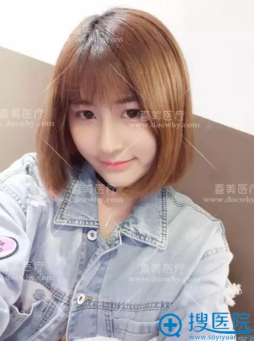 上海喜美异体肋软骨隆鼻3个月正面反馈效果图 上海喜美异体肋软骨隆鼻3个月正面反馈效果图