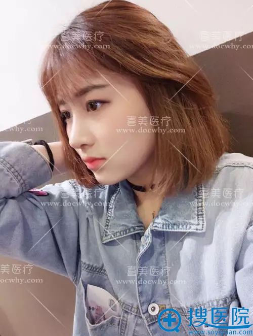 上海喜美<!--<i data=20240710 data-id=16268></i>-->异体肋软骨隆鼻案例3个月侧面效果图 上海喜美<!--<i data=20240710 data-id=16268></i>-->异体肋软骨隆鼻案例3个月侧面效果图