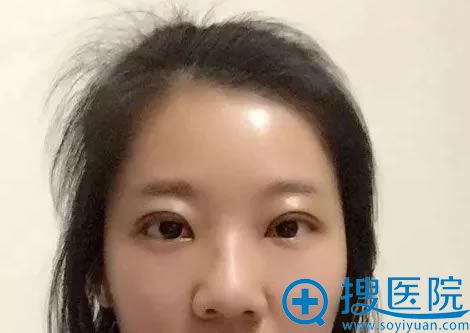 ����������ٻԺ��˫��Ƥ����5��Ч��