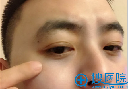 石家庄蓝山唐春香去眼袋术后效果 石家庄蓝山唐春香去眼袋术后效果