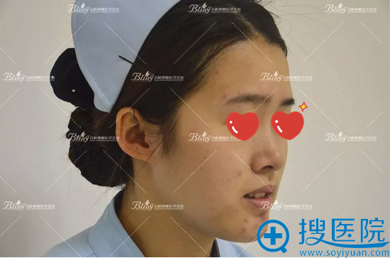 成都百龄博雅内部员工体验皮秒激光去痘印 一次治疗效果显著