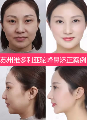 鼻子宽还驼峰找苏州维多利亚李寅院长做鼻综合矫正术1个月后
