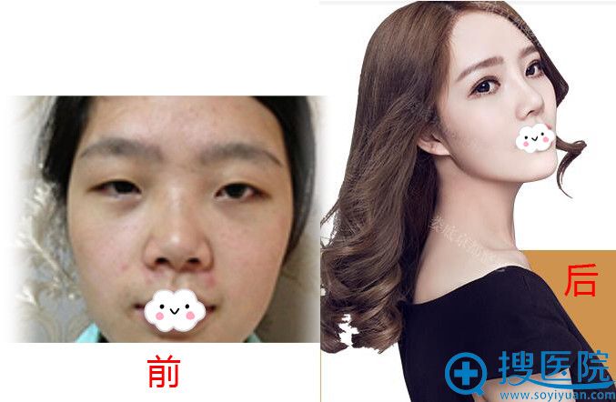 娄底京都双眼皮+隆鼻+垫下巴案例 娄底京都双眼皮+隆鼻+垫下巴案例
