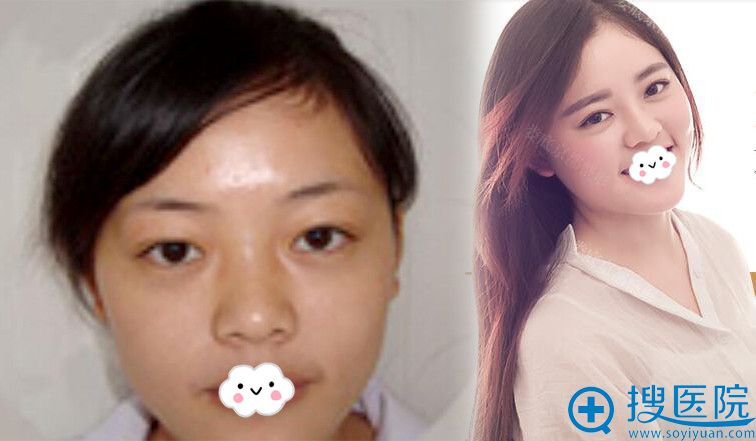 娄底京都隆鼻+垫下巴案例 娄底京都隆鼻+垫下巴案例