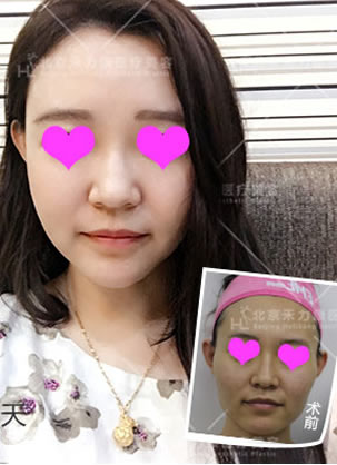 ��������������ѵ������֬������沿������50��ָ�Ч��ͼƬ