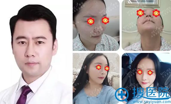 北京美莱<!--<i data=20240710 data-id=16808></i>-->和隆鼻模特案例 北京美莱<!--<i data=20240710 data-id=16808></i>-->和隆鼻模特案例