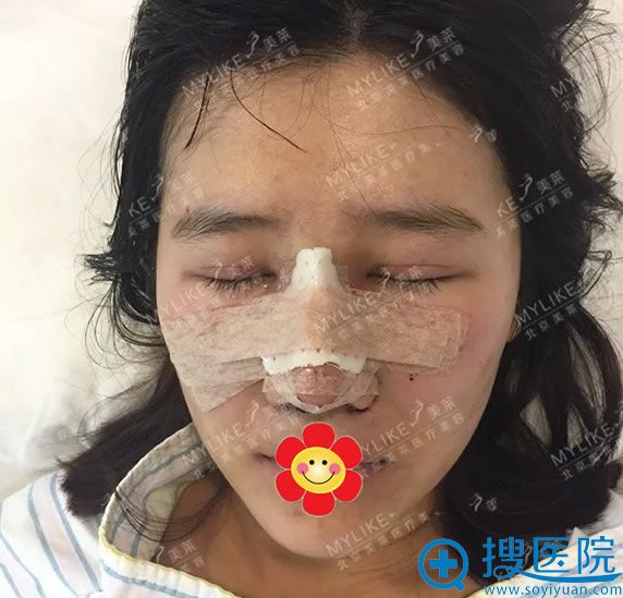 找北京美莱<!--<i data=20240710 data-id=16808></i>-->做鼻子1天恢复照 找北京美莱<!--<i data=20240710 data-id=16808></i>-->做鼻子1天恢复照