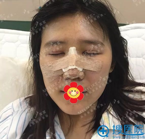 做完肋骨隆鼻手术后2天恢复照 做完肋骨隆鼻手术后2天恢复照