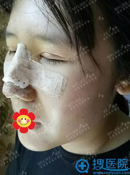 暑假到北京美莱做综合隆鼻术后3天 暑假到北京美莱做综合隆鼻术后3天