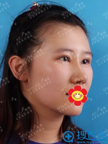 <!--<i data=20240710 data-id=16808></i>-->肋软骨隆鼻案例10天效果 <!--<i data=20240710 data-id=16808></i>-->肋软骨隆鼻案例10天效果