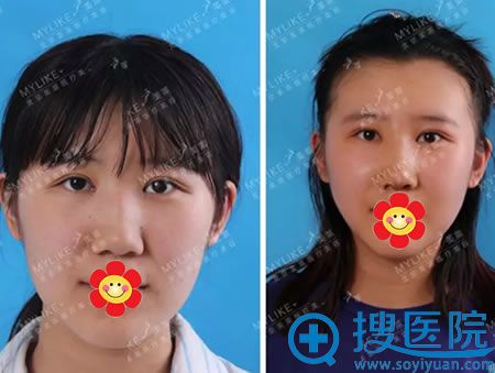 北京美莱驼峰鼻矫正案例对比图 北京美莱驼峰鼻矫正案例对比图