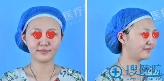 洛阳安和瘦脸真实案例:全面部线雕+玻尿酸填充轻松打造小V脸