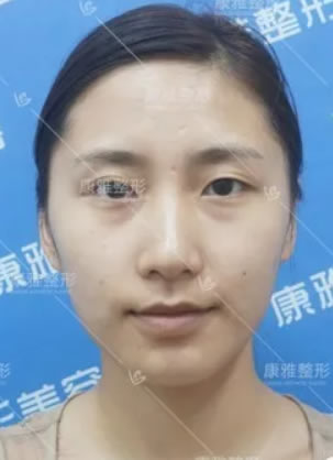 从重庆康雅美鼻归来 感谢银山院长帮我做鼻翼缩小隆鼻和双眼皮