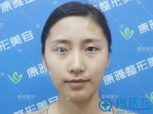在康雅做鼻翼缩小综合手术前 在康雅做鼻翼缩小综合手术前