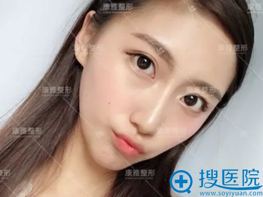 在康雅做完鼻翼缩小1个月效果 在康雅做完鼻翼缩小1个月效果