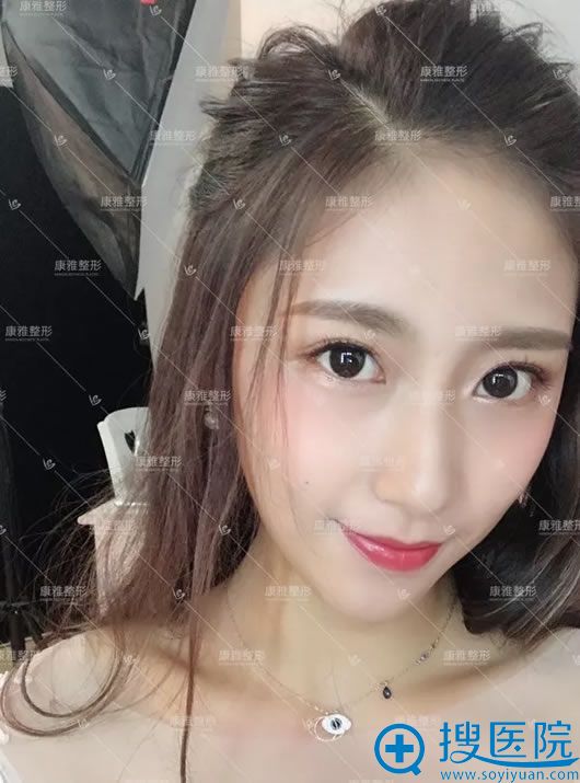<!--<i data=20240710 data-id=12505></i>-->银山鼻综合案例3个月效果 <!--<i data=20240710 data-id=12505></i>-->银山鼻综合案例3个月效果