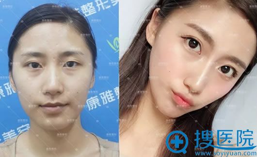 康雅银山鼻翼缩小综合案例对比图 康雅银山鼻翼缩小综合案例对比图