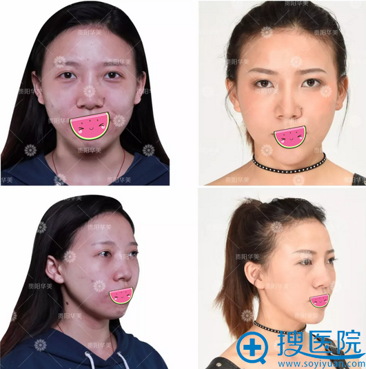 贵阳华美玻尿酸面部精雕术前术后对比 贵阳华美玻尿酸面部精雕术前术后对比