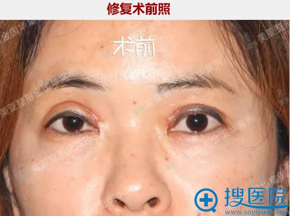案例!双眼皮失败的我找武汉美亚金国华做二次修复后摆脱了恶梦