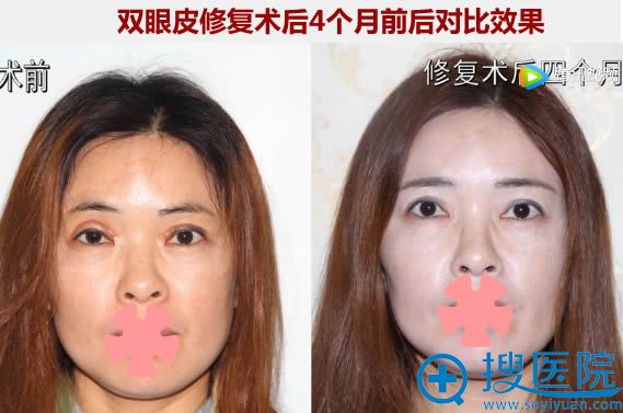 金国华双眼皮失败二次修复案例及4个月对比效果 金国华双眼皮失败二次修复案例及4个月对比效果