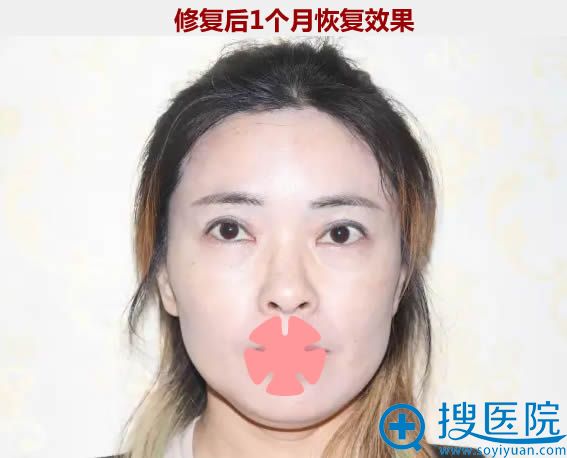 金国华给我做完双眼皮修复术后一个月效果 金国华给我做完双眼皮修复术后一个月效果