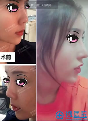 咨询哈尔滨伊美尔和211隆鼻失败咋整 黄志祥帮我做了鼻综合修复