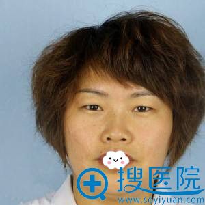 昆明丽都谁做鼻子比较好?看张院长为我做综合隆鼻1月效果