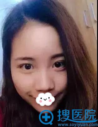 平凡女生到金华维多利亚做了黄金综合隆鼻术后美丽翘楚
