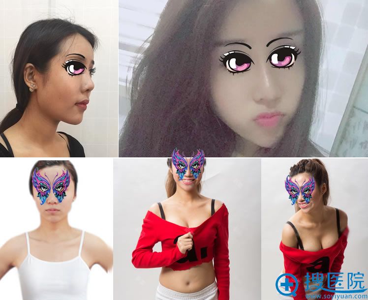 <!--<i data=20240710 data-id=12669></i>-->隆鼻和隆胸真人案例 <!--<i data=20240710 data-id=12669></i>-->隆鼻和隆胸真人案例