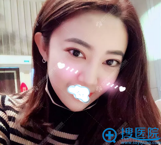 惊艳亮相:沈阳百嘉丽整形美容医院全切双眼皮术后500天恢复效果