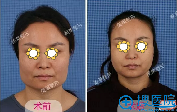 罗金超下颌角整形术后10天对比 罗金超下颌角整形术后10天对比
